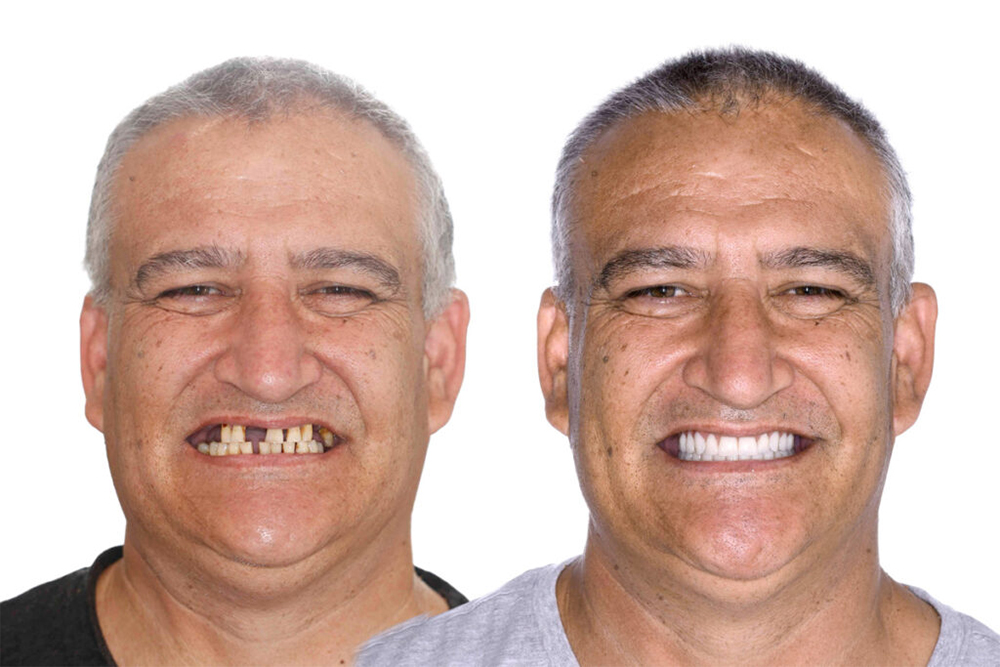All on 4 Brisbane – A New Smile in Just One Day